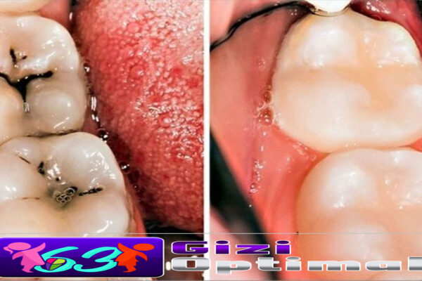 Langkah Perawatan Gigi untuk Mencegah Gigi Berlubang